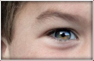 Choroideremia CHM Is A Rare Inherited Disorder That Causes Progressive Loss Of Vision Due To Degeneration The Choroid And Retina Which Caused By Choroideremia CHM Is A Rare Inherited Disorder That Causes Progressive Loss Of Vision Due To Degeneration The Choroid And Retina Which Caused By